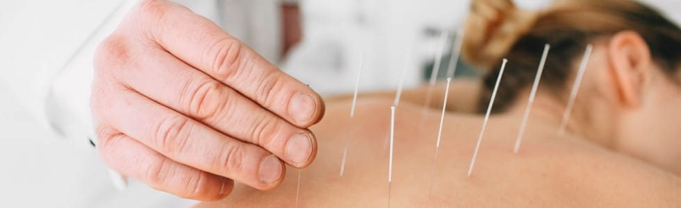 Ein Arzt behandelt eine Frau mit Akupunkturnadeln